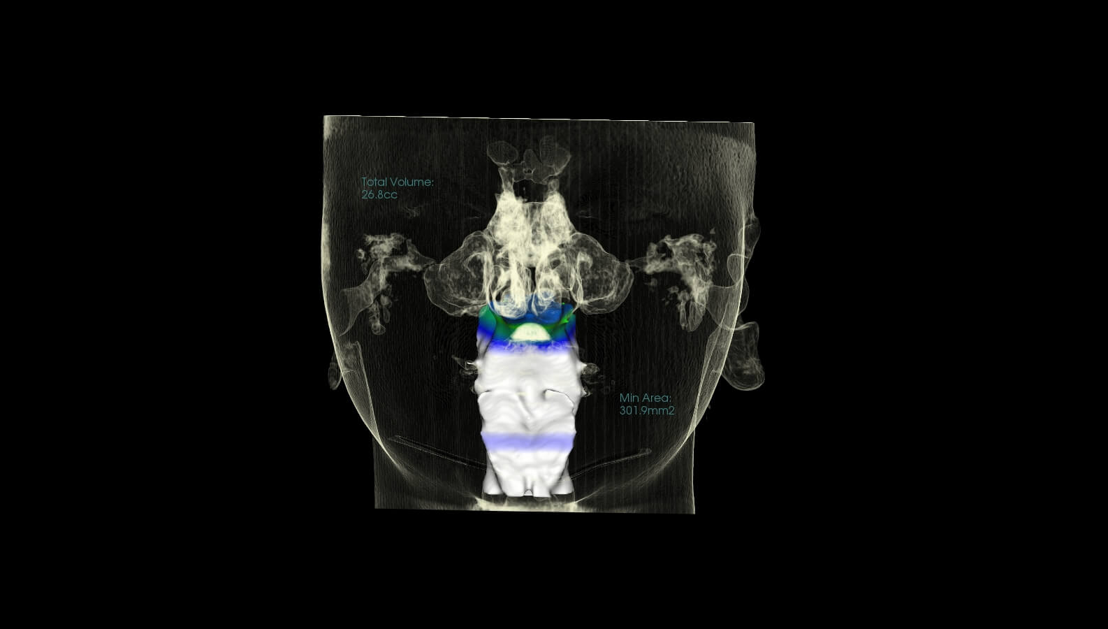 Marlo Miller - Before & After Airway Photos